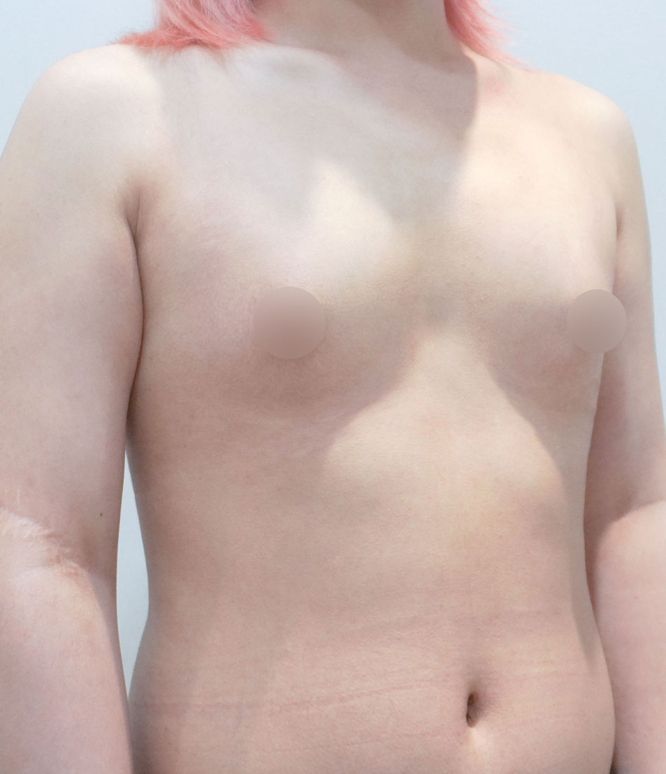 ftm breast before after korea