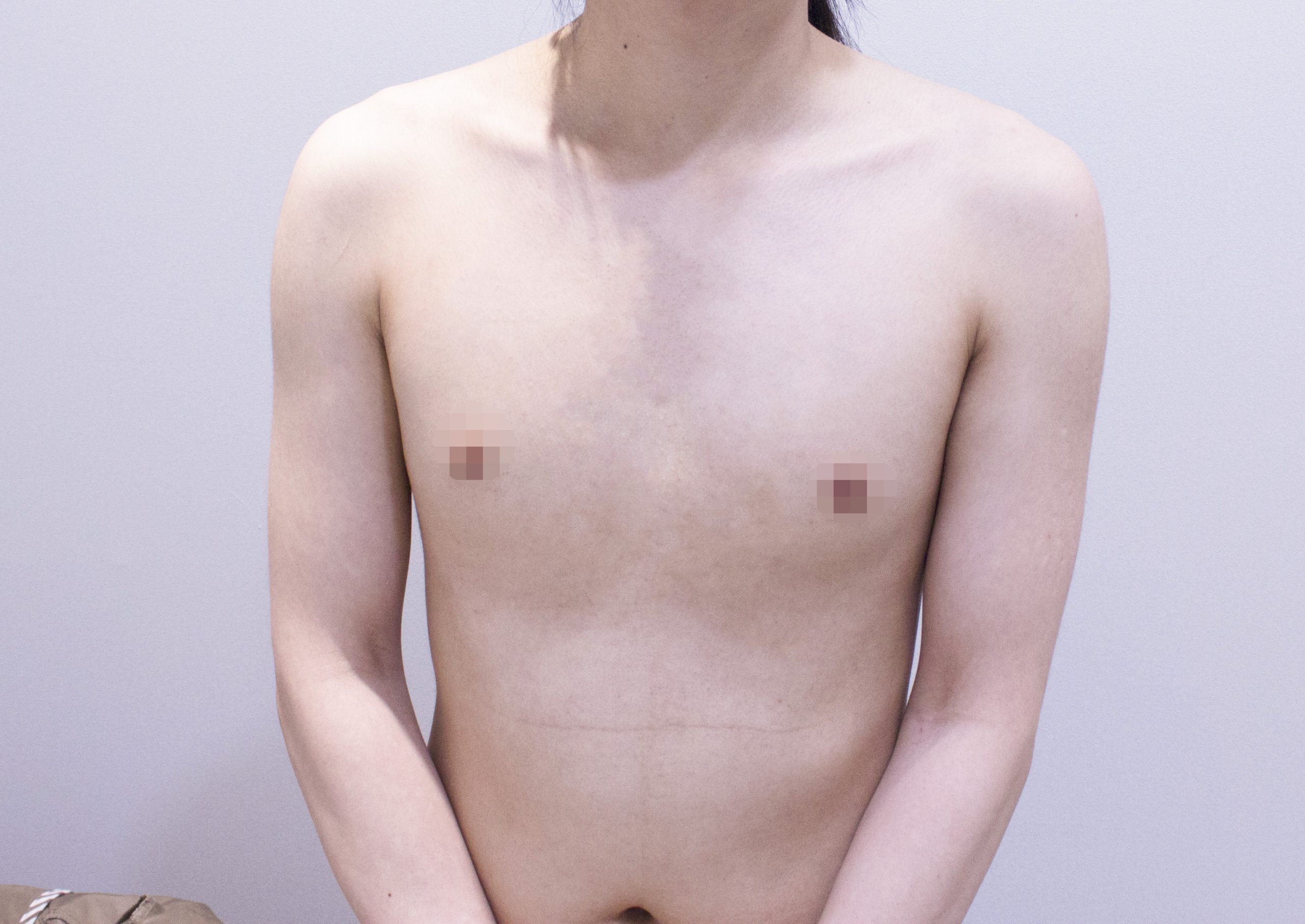 ftm breast before after korea