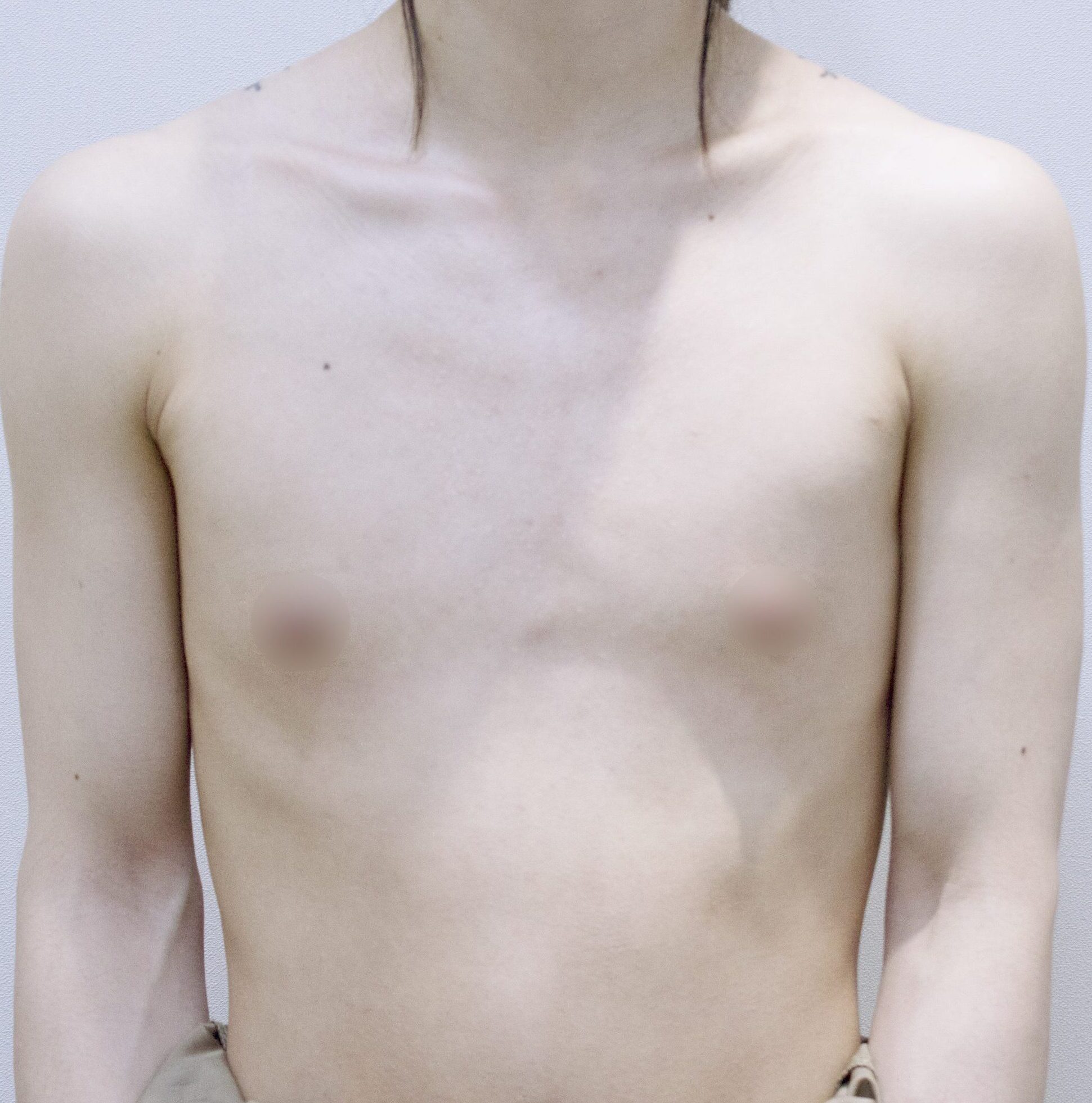 ftm breast before after korea