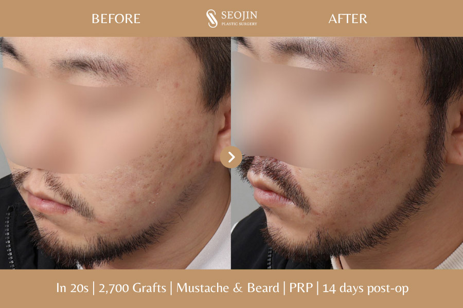 hair transplant in korea before and after