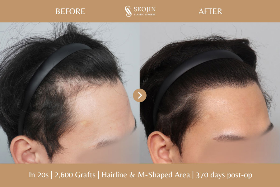 hair transplant in korea before and after