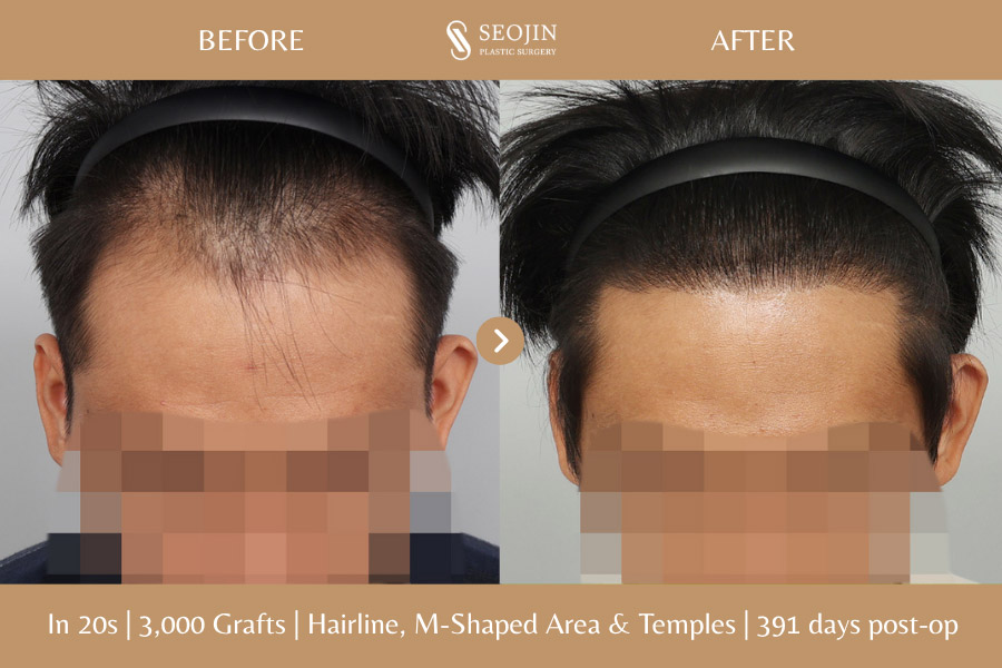 hair transplant in korea before and after