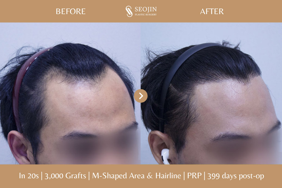 hair transplant in korea before and after