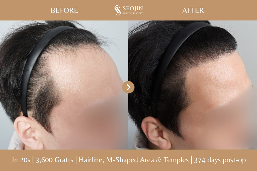 hair transplant in korea before and after