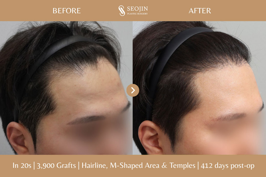 hair transplant in korea before and after