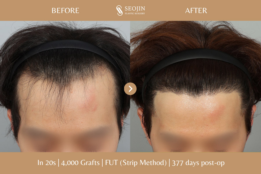 hair transplant in korea before and after