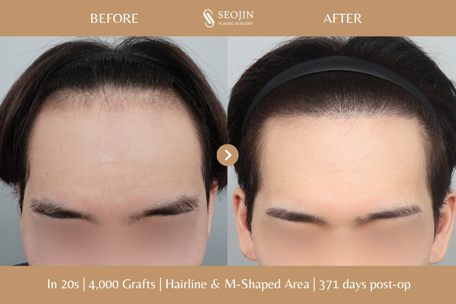 hair transplant in korea before and after