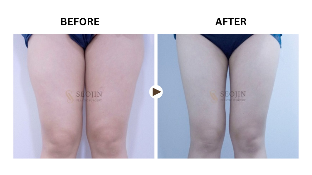 Thigh Liposuction Before and After